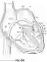 Fig. 18 - REPLACEMENT HEART VALVE SYSTEMS AND METHODS