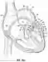 Fig. 19 - REPLACEMENT HEART VALVE SYSTEMS AND METHODS