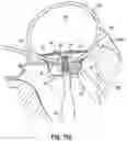 Fig. 21 - REPLACEMENT HEART VALVE SYSTEMS AND METHODS