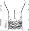 Fig. 01 - STENT OF AORTIC VALVE