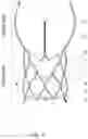 Fig. 05 - STENT OF AORTIC VALVE