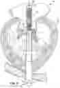 Fig. 07 - APPARATUS AND METHOD FOR REPLACING A DISEASED CARDIAC VALVE