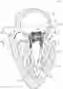 Fig. 01 - MITRAL VALVE PROSTHESIS IMPLANTATION