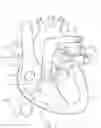 Fig. 02 - MITRAL VALVE PROSTHESIS IMPLANTATION