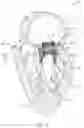 Fig. 03 - MITRAL VALVE PROSTHESIS IMPLANTATION