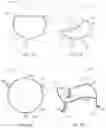 Fig. 06 - MITRAL VALVE PROSTHESIS IMPLANTATION
