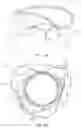 Fig. 07 - MITRAL VALVE PROSTHESIS IMPLANTATION