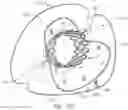 Fig. 10 - MITRAL VALVE PROSTHESIS IMPLANTATION