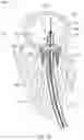 Fig. 15 - MITRAL VALVE PROSTHESIS IMPLANTATION