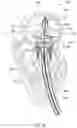 Fig. 16 - MITRAL VALVE PROSTHESIS IMPLANTATION