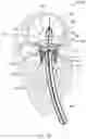 Fig. 17 - MITRAL VALVE PROSTHESIS IMPLANTATION