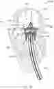 Fig. 18 - MITRAL VALVE PROSTHESIS IMPLANTATION