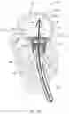 Fig. 19 - MITRAL VALVE PROSTHESIS IMPLANTATION