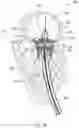 Fig. 20 - MITRAL VALVE PROSTHESIS IMPLANTATION