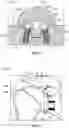 Fig. 09 - CONVERTIBLE ORTHOPAEDIC IMPLANT SYSTEMS AND METHODS
