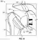 Fig. 10 - CONVERTIBLE ORTHOPAEDIC IMPLANT SYSTEMS AND METHODS
