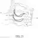 Fig. 20 - Spinal Prothesis
