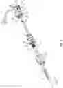 Fig. 04 - Surgical instrument and method