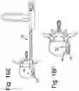 Fig. 28 - DEVICES AND METHODS FOR SPINAL IMPLANTATION