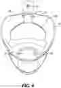 Fig. 05 - Modular adjustable prosthetic volume compensation system