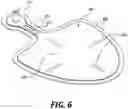 Fig. 07 - Modular adjustable prosthetic volume compensation system