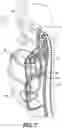 Fig. 08 - Modular adjustable prosthetic volume compensation system