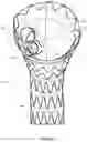 Fig. 06 - Thoracic aorta stent graft with access region