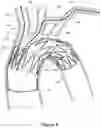 Fig. 07 - Thoracic aorta stent graft with access region