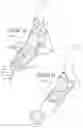 Fig. 44 - POTENTIATING SUPPORT WITH EXPANDABLE FRAMEWORK