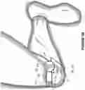 Fig. 11 - THERAPEUTIC DEVICE Applying COMPRESSION AND HEAT TREATMENT