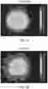 Fig. 08 - Methods, Computer-Readable Media, and Systems for Treating a Cornea