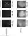 Fig. 17 - Methods, Computer-Readable Media, and Systems for Treating a Cornea