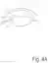 Fig. 05 - CORNEAL REFRACTIVE CORRECTION USING  A SURFACE TREATMENT AFTER CORNEAL RESHAPING