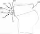 Fig. 01 - Umbilical Cord Cover