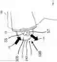 Fig. 05 - Umbilical Cord Cover