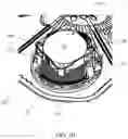 Fig. 05 - SYSTEM FOR MOUNTING INELASTIC COMPONENTS TO A FLEXIBLE MATERIAL TO APPLY COMPRESSIVE AND THERMAL THERAPY