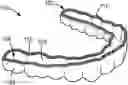 Fig. 01 - ANTIMICROBIAL DENTAL APPLIANCE