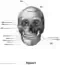 Fig. 06 - ENHANCED SYSTEM AND METHOD FOR USING A PRESSURIZED HYALURONIC ACID INJECTION DEVICE FOR AESTHETIC ENHANCEMENT OF SKIN APPEARANCE