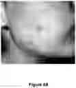 Fig. 10 - ENHANCED SYSTEM AND METHOD FOR USING A PRESSURIZED HYALURONIC ACID INJECTION DEVICE FOR AESTHETIC ENHANCEMENT OF SKIN APPEARANCE