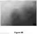 Fig. 11 - ENHANCED SYSTEM AND METHOD FOR USING A PRESSURIZED HYALURONIC ACID INJECTION DEVICE FOR AESTHETIC ENHANCEMENT OF SKIN APPEARANCE