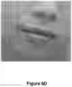 Fig. 13 - ENHANCED SYSTEM AND METHOD FOR USING A PRESSURIZED HYALURONIC ACID INJECTION DEVICE FOR AESTHETIC ENHANCEMENT OF SKIN APPEARANCE