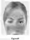 Fig. 15 - ENHANCED SYSTEM AND METHOD FOR USING A PRESSURIZED HYALURONIC ACID INJECTION DEVICE FOR AESTHETIC ENHANCEMENT OF SKIN APPEARANCE