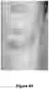 Fig. 17 - ENHANCED SYSTEM AND METHOD FOR USING A PRESSURIZED HYALURONIC ACID INJECTION DEVICE FOR AESTHETIC ENHANCEMENT OF SKIN APPEARANCE