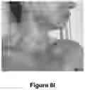 Fig. 18 - ENHANCED SYSTEM AND METHOD FOR USING A PRESSURIZED HYALURONIC ACID INJECTION DEVICE FOR AESTHETIC ENHANCEMENT OF SKIN APPEARANCE