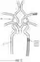 Fig. 03 - Catheter with heat transfer minimizing annular space