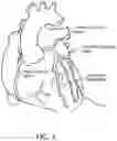 Fig. 04 - Catheter with heat transfer minimizing annular space