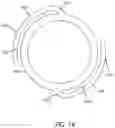 Fig. 17 - Catheter with heat transfer minimizing annular space