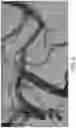 Fig. 05 - ASPIRATION CATHETER SYSTEMS AND METHODS OF USE