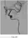 Fig. 17 - ASPIRATION CATHETER SYSTEMS AND METHODS OF USE