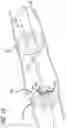 Fig. 06 - Pulmonary Embolism Removal System